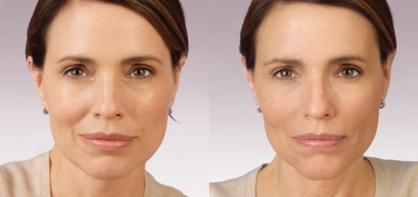 Juvéderm® Before and After photo by Bayview Plastic Surgery in Houston, TX